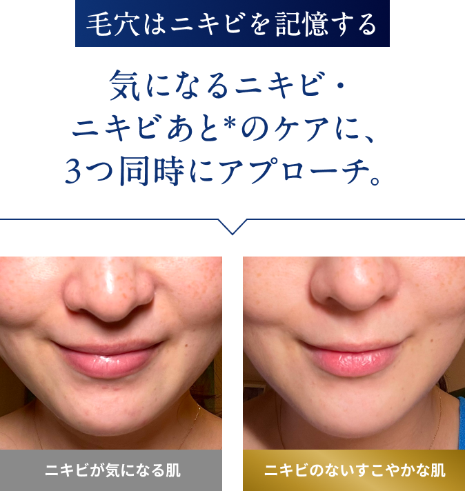 毛穴はニキビを記憶する 気になるニキビ・ ニキビあと＊のケアに、 3つ同時にアプローチ。
