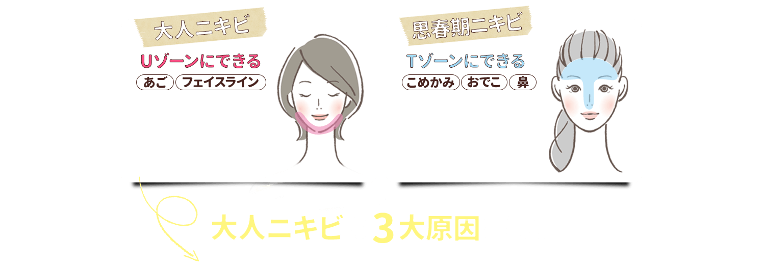 大人ニキビの3大原因とは?