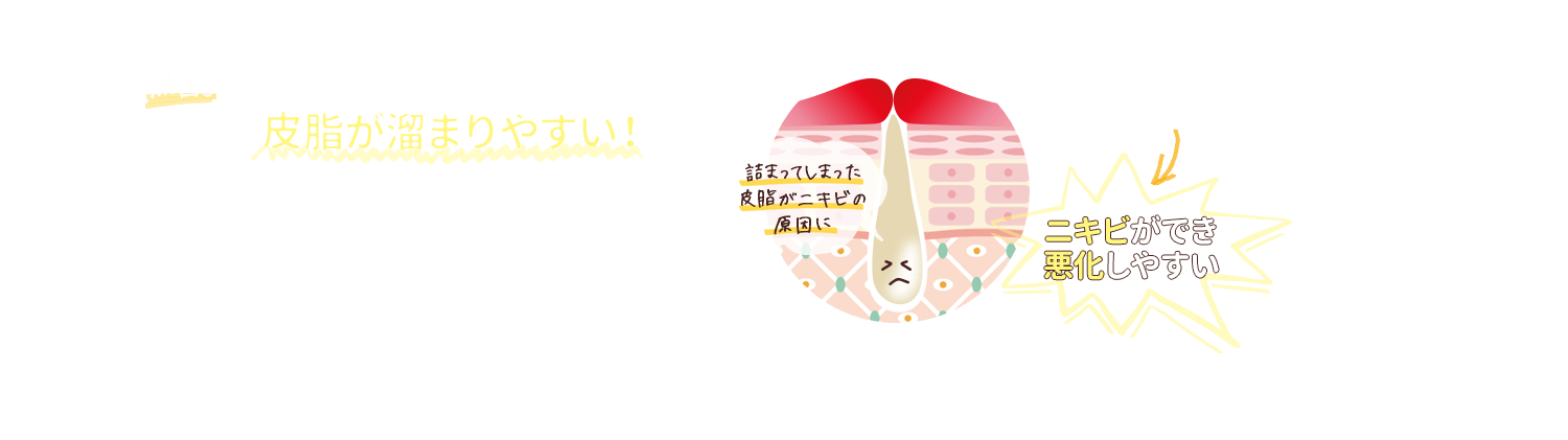 大人ニキビのできやすい箇所は皮脂が溜まりやすい!