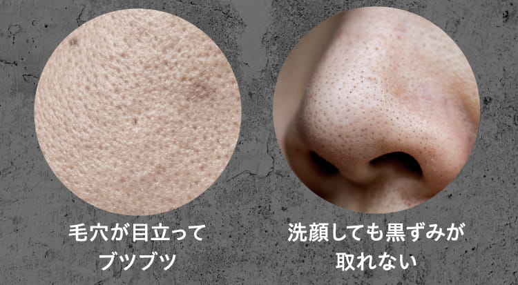 毛穴が目立ってブツブツ 洗顔しても黒ずみが取れない