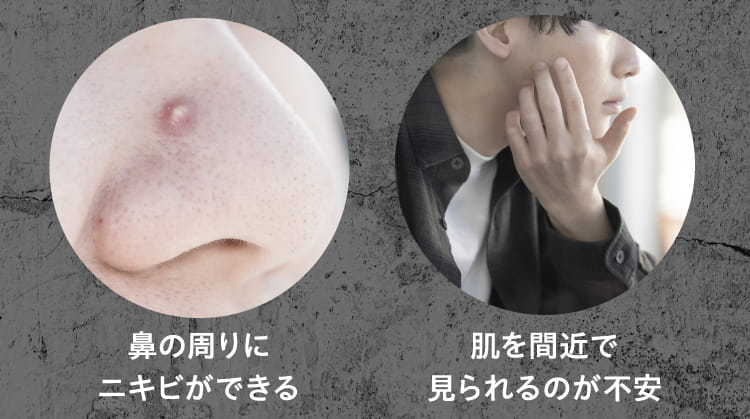 鼻の周りにニキビができる 肌を間近で見られるのが不安