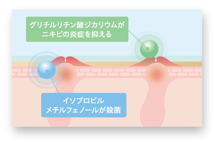 グリチルリチン酸ジカリウムがニキビの炎症を抑える イソプロピルメチルフェノールが殺菌