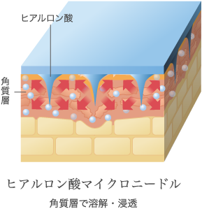 ヒアルロン酸マイクロニードル 角質層で溶解・浸透