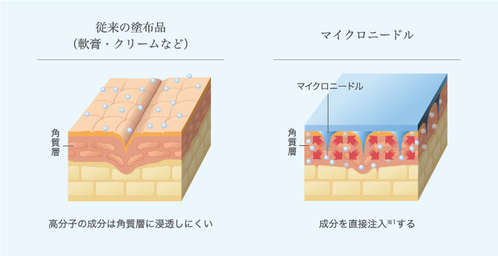 高分子成分を簡単・安全に皮膚内にリリース