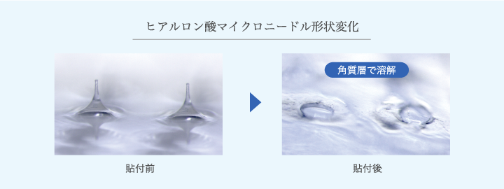 DDS(ドラッグデリバリーシステム)の新しい手法 溶けるマイクロニードルで薬剤の経皮吸収が確実に
