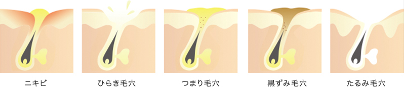 ニキビ、ひらき毛穴、つまり毛穴、黒ずみ毛穴、たるみ毛穴