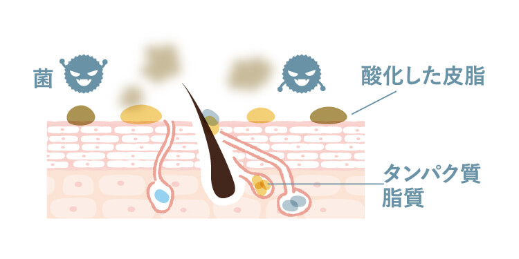 酸化した皮脂