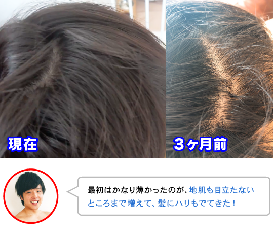 最初はかなり薄かったのが、地肌も目立たない
ところまで増えて、髪にハリもでてきた!