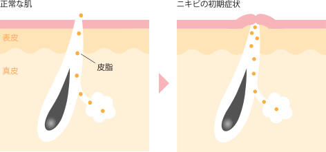 正常な肌・ニキビの初期症状の図